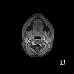 Base of skull rhabdomyosarcoma (Radiopaedia 32196-33142 T1 C+ fat sat 10).jpg