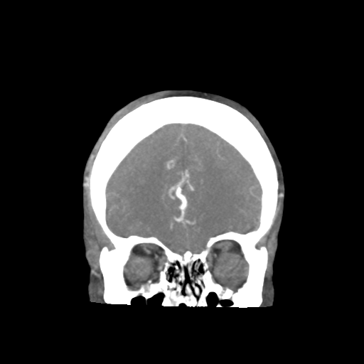 Basilar and bilateral vertebral artery occlusion (Radiopaedia 45592-49723 B 25).png
