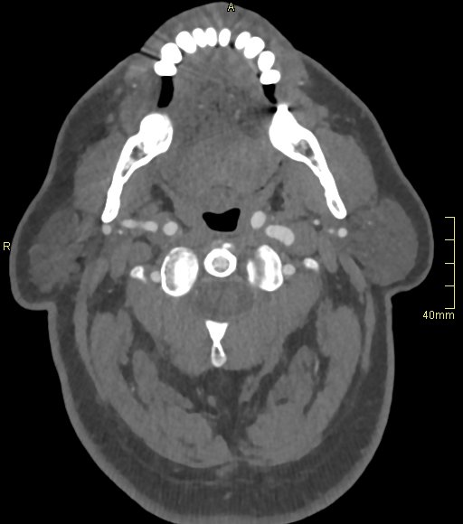 Basilar artery aneurysm (Radiopaedia 56261-62932 A 21).jpg