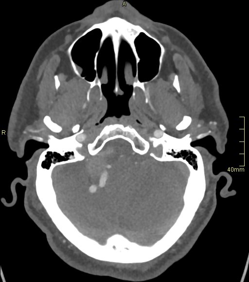 Basilar artery aneurysm (Radiopaedia 56261-62932 A 47).jpg