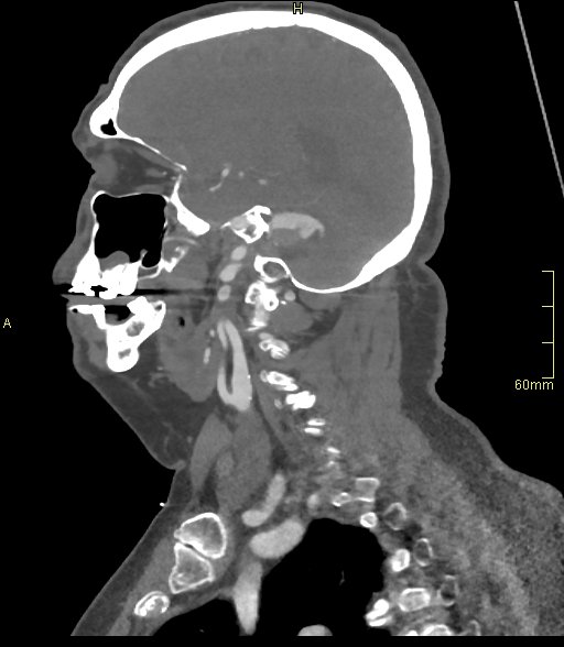 Basilar artery aneurysm (Radiopaedia 56261-62932 C 12).jpg