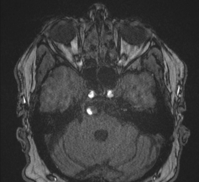 Basilar artery dissection (Radiopaedia 77032-88976 Axial TOF 55).jpg