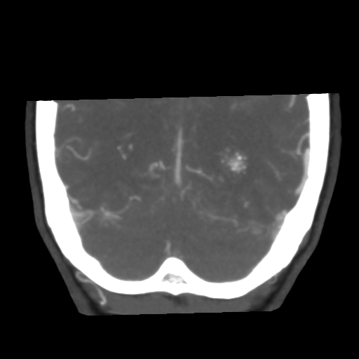 File:Basilar artery fenestration and aneurysms with subarachnoid hemorrhage (Radiopaedia 40066-42573 B 45).png