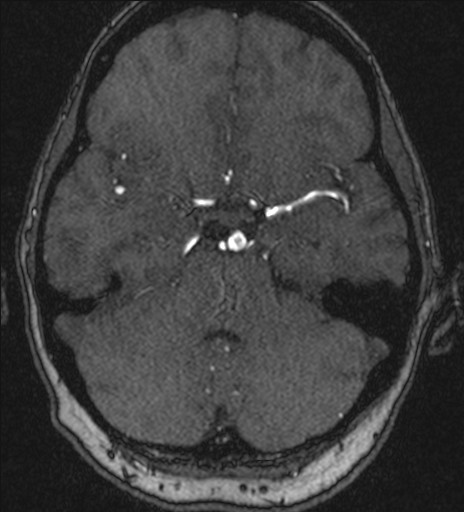 Basilar tip aneurysm (Radiopaedia 26504-26632 MRA 75).jpg
