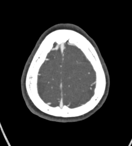 Basilar tip aneurysm with coiling (Radiopaedia 53912-60086 A 133).jpg