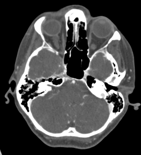 Basilar tip aneurysm with coiling (Radiopaedia 53912-60086 A 39).jpg