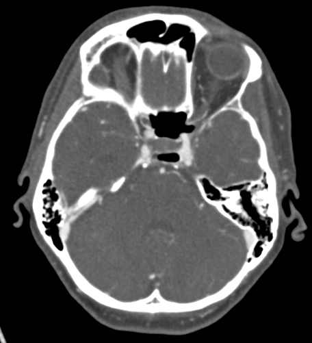 Basilar tip aneurysm with coiling (Radiopaedia 53912-60086 A 47).jpg