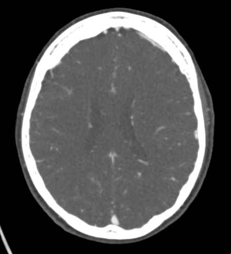 Basilar tip aneurysm with coiling (Radiopaedia 53912-60086 A 95).jpg
