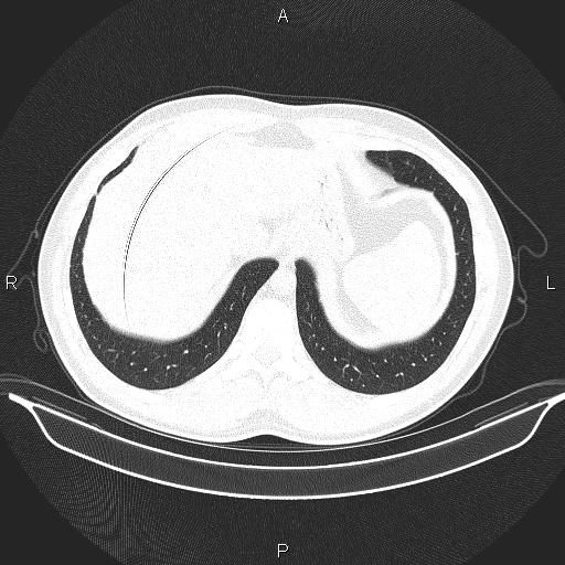 File:Beam hardening and ring artifacts (Radiopaedia 85323-100915 Axial lung window 66).jpg