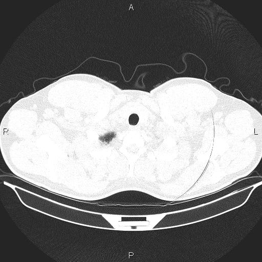 File:Beam hardening and ring artifacts (Radiopaedia 85323-100915 Axial lung window 7).jpg