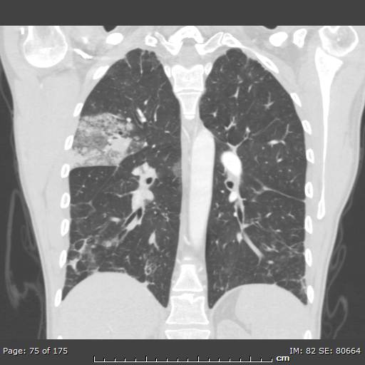 File:Behçet disease (Radiopaedia 44247-47889 Coronal lung window 21).jpg