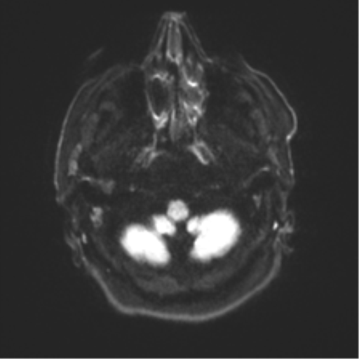 Behavioral variant frontotemporal dementia and late onset schizophrenia (Radiopaedia 52197-58083 Axial DTI Trace W 30).png
