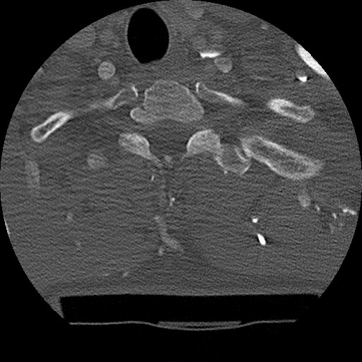 Benign post-traumatic pseudopneumoperitoneum (Radiopaedia 71199-81495 Axial bone window 28).jpg