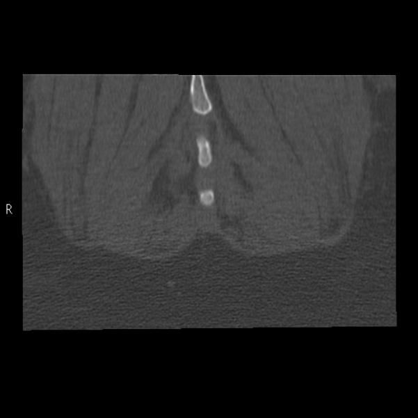 Bertolotti syndrome (Radiopaedia 24864-25128 Coronal bone window 54).jpg