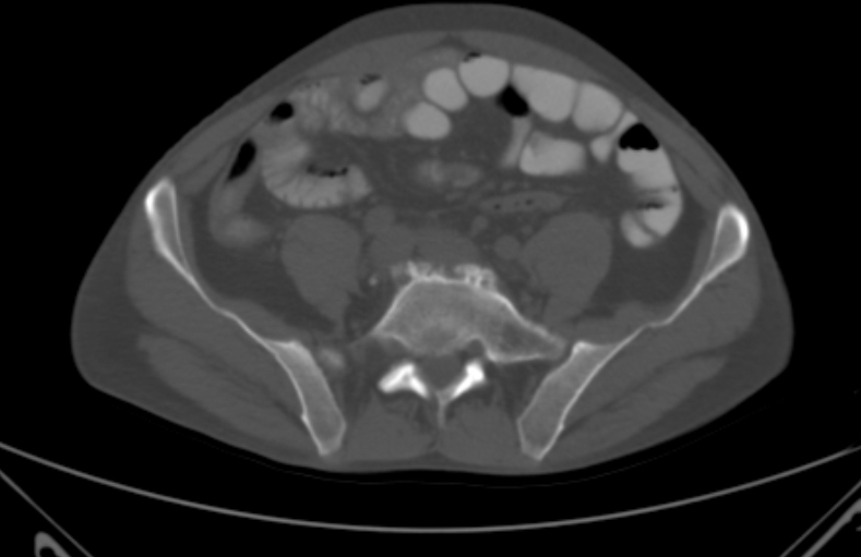 File:Bertolotti syndrome (Radiopaedia 58974-66235 Axial bone window 11).jpg