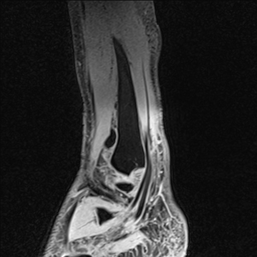 File:Bilateral Achilles tendon complete tear (Radiopaedia 81344-95051 Sagittal WE - Left 91).jpg