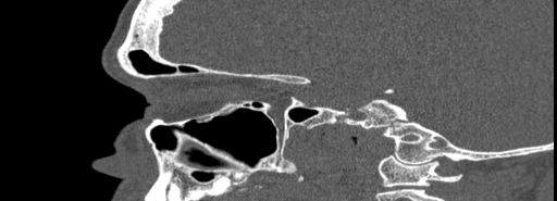 File:Bilateral Ectopic Infraorbital Nerves (Radiopaedia 49006-54084 Sagittal bone window 33).jpg