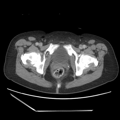File:Bilateral adrenal granulocytic sarcomas (chloromas) (Radiopaedia 78375-91007 A 117).jpg