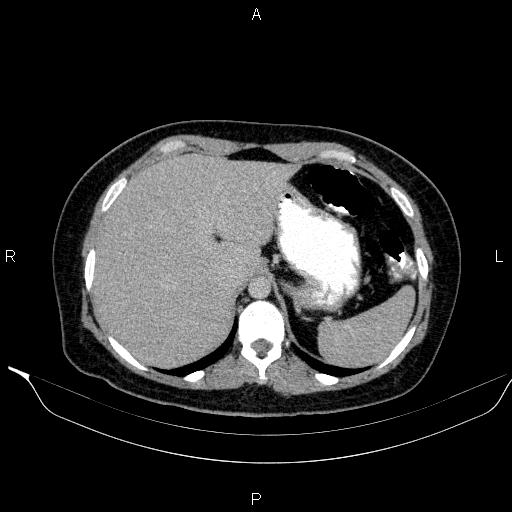 Bilateral adrenal myelolipoma (Radiopaedia 63058-71535 Axial C+ delayed 10).jpg