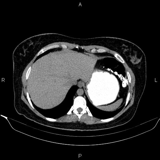 File:Bilateral adrenal myelolipoma (Radiopaedia 63058-71535 Axial non-contrast 19).jpg