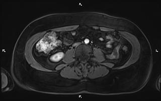 Bilateral adrenal myelolipoma (Radiopaedia 63058-71537 Axial T1 C+ fat sat 66).jpg