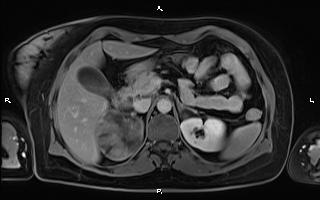 File:Bilateral adrenal myelolipoma (Radiopaedia 63058-71537 H 37).jpg