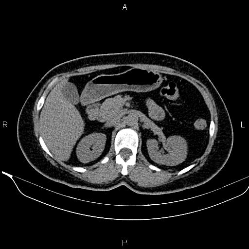 Bilateral benign adrenal adenomas (Radiopaedia 86912-103124 Axial non-contrast 42).jpg
