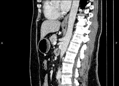 Bilateral benign adrenal adenomas (Radiopaedia 86912-103124 E 54).jpg