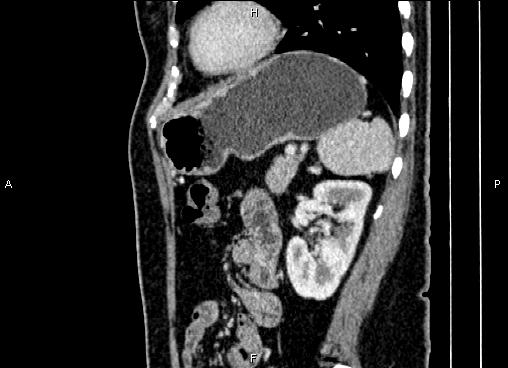 Bilateral benign adrenal adenomas (Radiopaedia 86912-103124 E 72).jpg