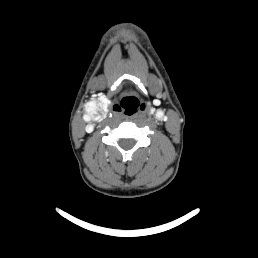 File:Bilateral carotid body tumors (Radiopaedia 52899-58827 A 4).jpg