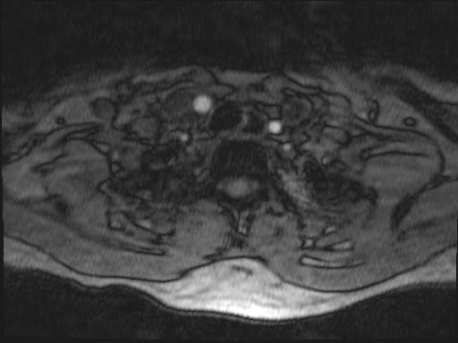 Bilateral carotid body tumors and right glomus jugulare tumor (Radiopaedia 20024-20060 Axial MRA 187).jpg