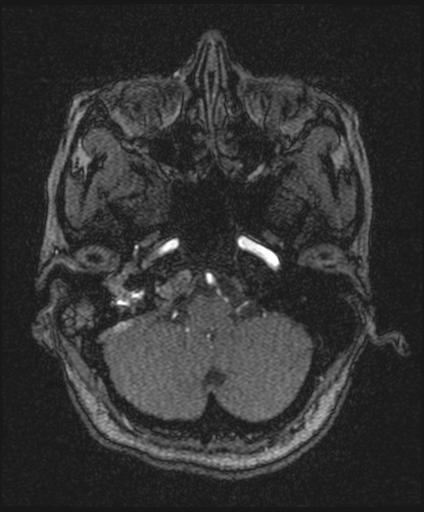 Bilateral carotid body tumors and right glomus jugulare tumor (Radiopaedia 20024-20060 Axial MRA 34).jpg