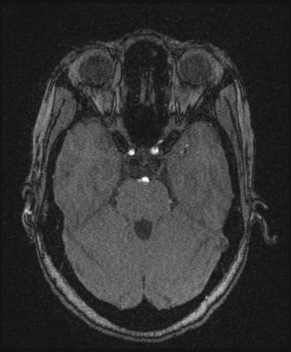 Bilateral carotid body tumors and right glomus jugulare tumor (Radiopaedia 20024-20060 Axial MRA 60).jpg