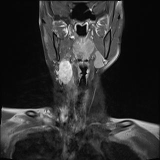 File:Bilateral carotid body tumors and right jugular paraganglioma (Radiopaedia 20024-20060 None 5).jpg