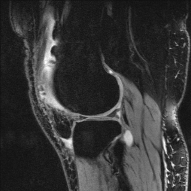 Bilateral focal pigmented villonodular synovitis (Radiopaedia 67643-77046 G 46).jpg