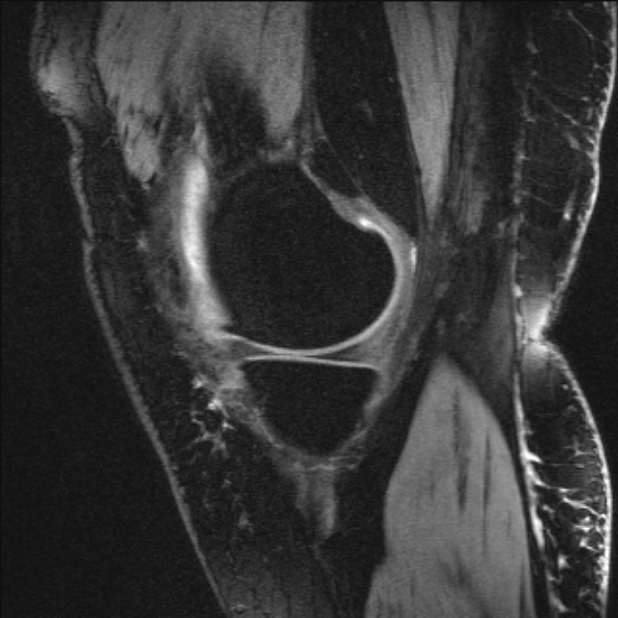 Bilateral focal pigmented villonodular synovitis (Radiopaedia 67643-77073 Sagittal T1 vibe 50).jpg