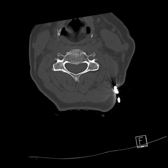 Bilateral occipital condyle fractures (type 3) (Radiopaedia 87672-104086 Axial bone window 40).jpg