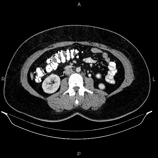 Bilateral ovarian dermoid cysts (Radiopaedia 85785-101603 A 55).jpg