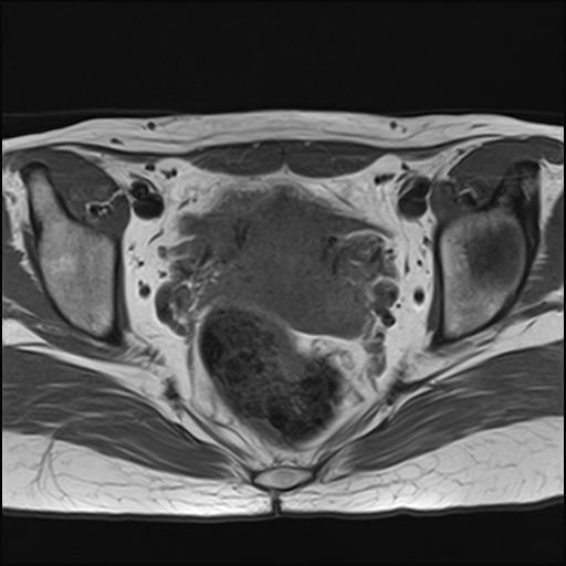 File:Bilateral ovarian endometriomas (Radiopaedia 87085-103347 Axial T1 13).jpg