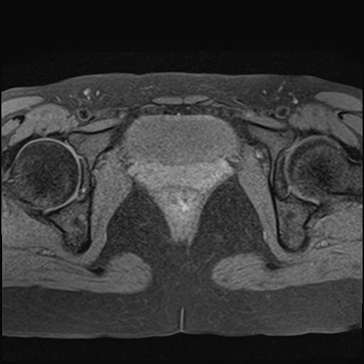 File:Bilateral ovarian endometriomas (Radiopaedia 87085-103347 Axial T1 fat sat 18).jpg