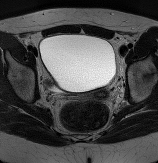 File:Bilateral ovarian fibrothecomas - adolescent (Radiopaedia 86604-102707 Axial T2 28).jpg