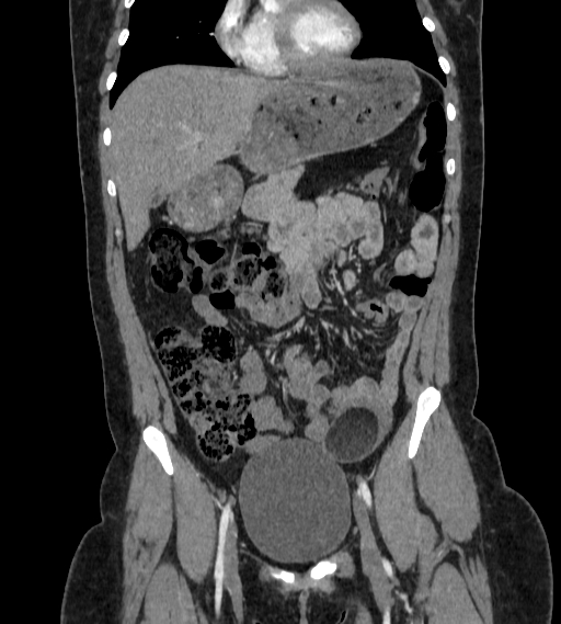 Bilateral ovarian mature cystic teratomas (Radiopaedia 79373-92457 B 17).jpg