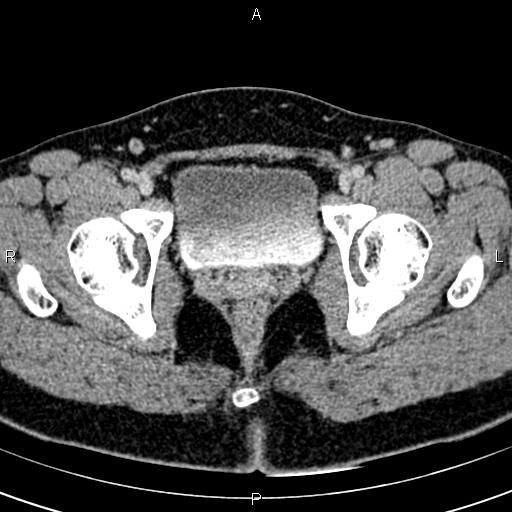 Bilateral ovarian teratoma (Radiopaedia 83131-97503 B 69).jpg