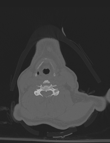 File:Bilateral perched facet joint (Radiopaedia 63149-71669 Axial bone window 35).jpg