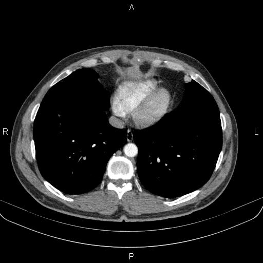 Bilateral pulmonary AVM (Radiopaedia 83134-97505 A 54).jpg