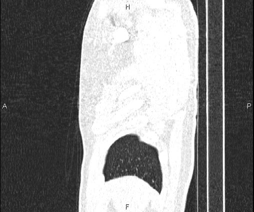 Bilateral pulmonary AVM (Radiopaedia 83134-97505 Sagittal lung window 18).jpg