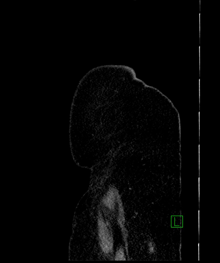 Bilateral sporadic synchronous clear cell renal cell carcinoma (Radiopaedia 85035-100575 E 6).jpg