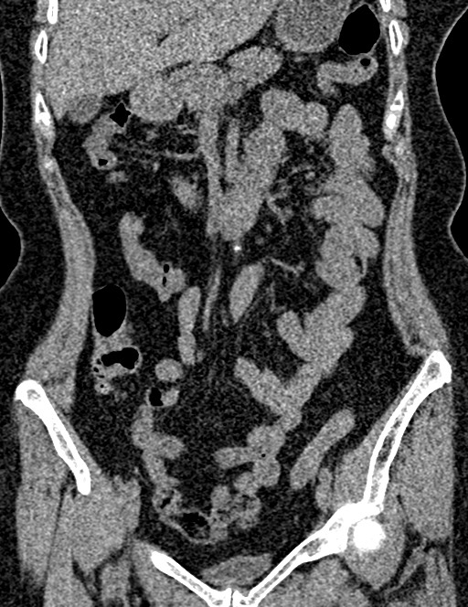 Bilateral staghorn calculi (Radiopaedia 59475-66842 Coronal non-contrast 49).jpg