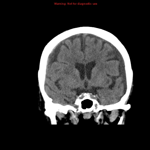 File:Bilateral subdural hemorrhage (Radiopaedia 8819-9620 Coronal non-contrast 3).jpg