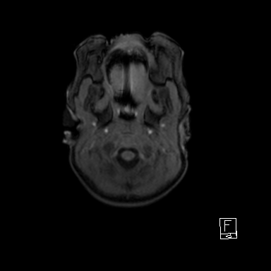 File:Bilateral subdural hemorrhage and parietal skull fracture (Radiopaedia 26058-26190 Axial T1 3).png